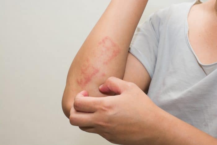 Mengenali Gejala Awal HIV yang Bisa Muncul Setelah Paparan Pertama