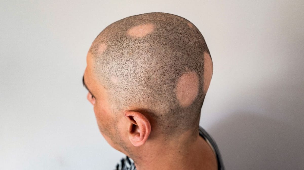 Efek Terapi Obat ARV pada Kerontokan Rambut