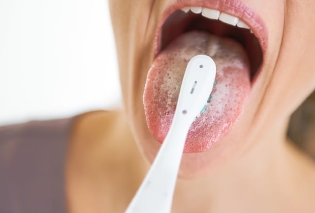 Apakah Lidah Berwarna Putih Gejala HIV?