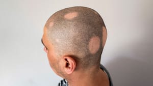 Efek Terapi Obat ARV pada Kerontokan Rambut